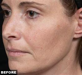 Thermage® Skin Tightening Treatments in NYC + Greenwich, CT .
